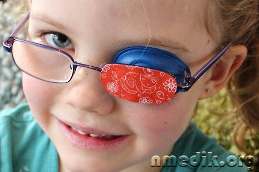 Амблиопия Амблиопия
