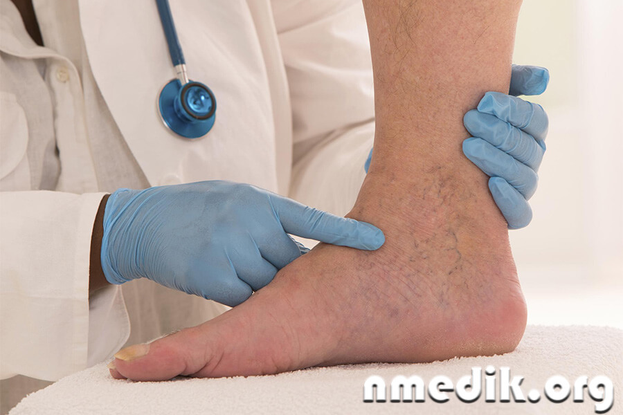 Эндартериит Эндартериит