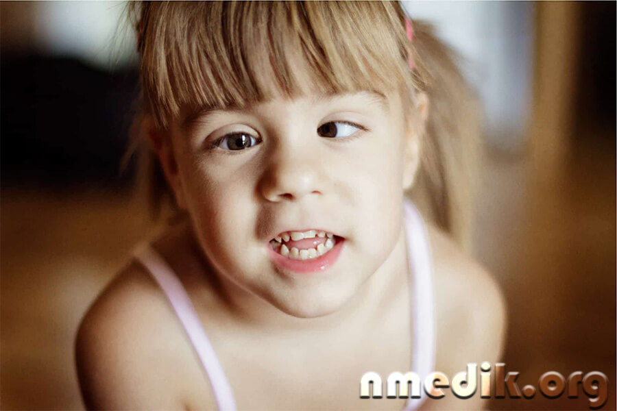 Косоглазие Косоглазие