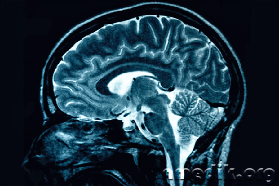 Рассеянный склероз Рассеянный склероз