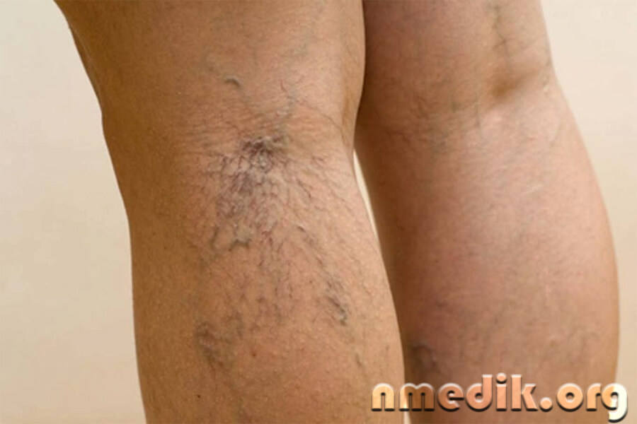 Венозная недостаточность Венозная недостаточность